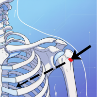 Localización del húmero proximal para acceso intraóseo