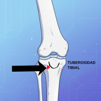 Punto de punción en la tibia proximal